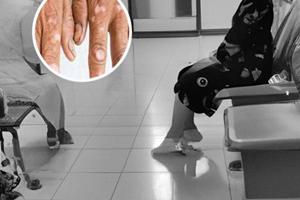 銀屑病和白癜風是一個病嗎