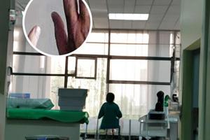 308激光治療儀治白斑效果怎么樣好不好