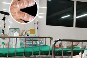 輕度色素脫失癥早期癥狀表現(xiàn)