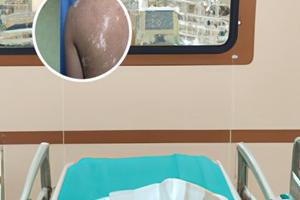 小孩臉上長白斑用什么藥好些呢怎么治療